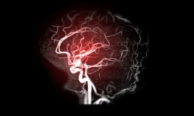 Stroke , strokes, brain, body, caregiver, support